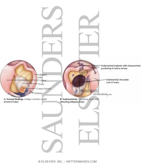 Endometriosis: Laparoscopic Views