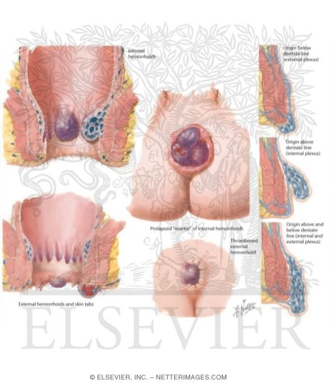 Hemorrhoids