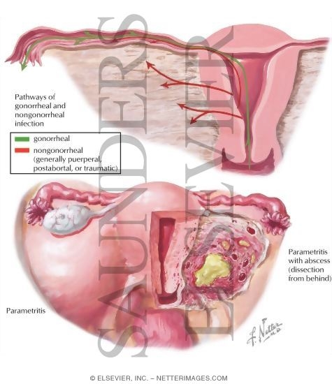 Pelvic Inflammatory Disease (PID)