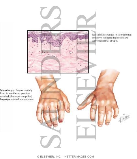 Progressive Systemic Sclerosis (Scleroderma)