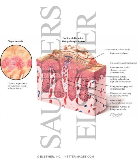 Watermarked preview of labeled image: Plaque Psoriasis