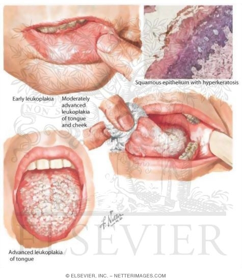 Leukoplakia