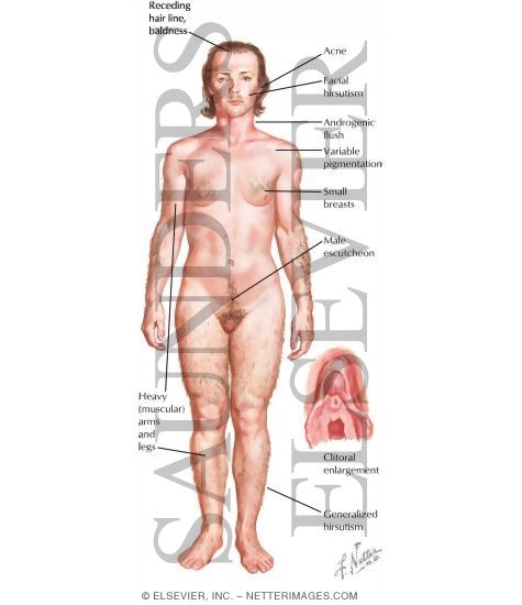 Clinical Manifestations of Hyperandrogenism