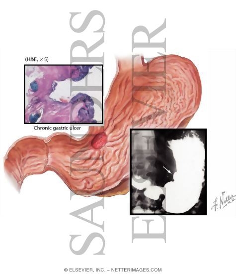Watermarked preview of labeled image: Peptic Ulcer Disease: Chronic Gastric Ulcers
