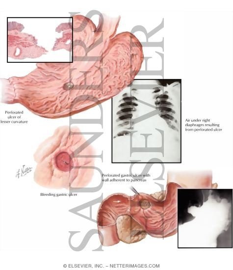 Watermarked preview of labeled image: Peptic Ulcer Disease: Complications of Gastric and Duodenal Ulcers