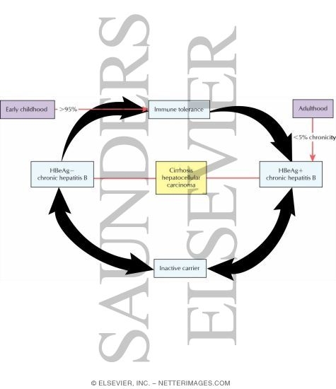 Watermarked preview of labeled image: Natural History of HBV Infection
