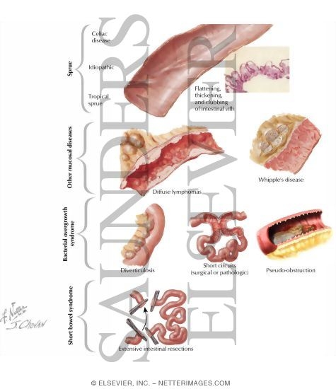 Malabsorption Syndrome: Small Intestinal Causes