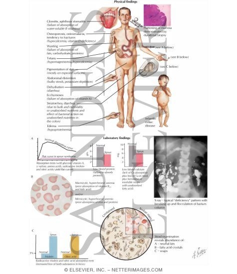 Advanced Malabsorption Syndrome