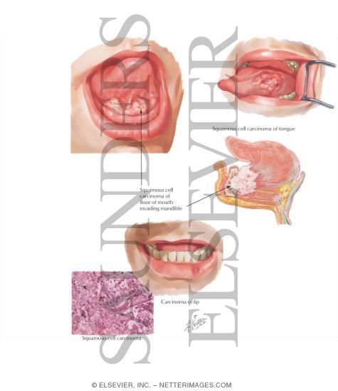 Malignant Tumors of Oral Cavity