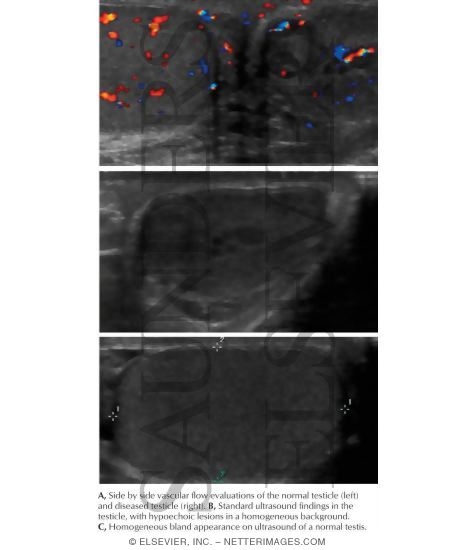 Watermarked preview of labeled image: Ultrasound Findings In the Testicle