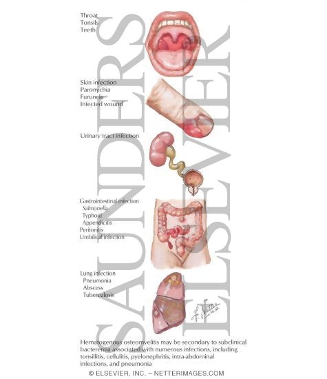 Watermarked preview of labeled image: Hematogenous Osteomyelitis