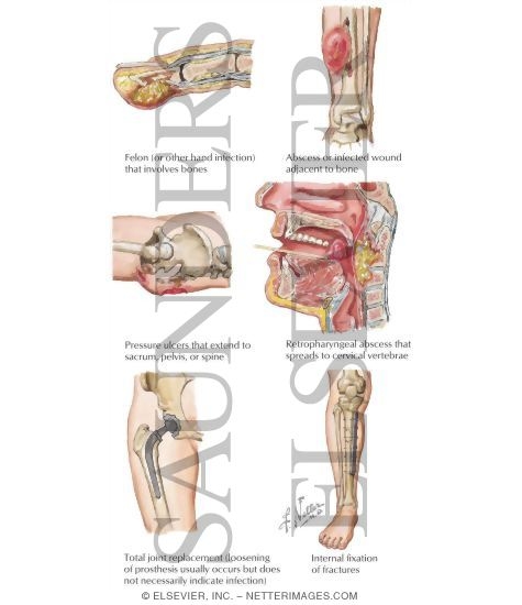 Examples of Contiguous Infections That May Be Associated With Osteomyelitis
