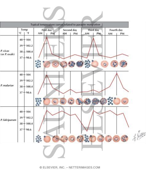 Watermarked preview of labeled image: Malaria: Clinical Course and Diagnosis