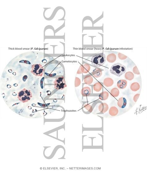 Watermarked preview of labeled image: Malaria: Clinical Course and Diagnosis
