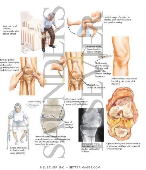 Watermarked preview of labeled image: Clinical Findings In Osteoarthritis