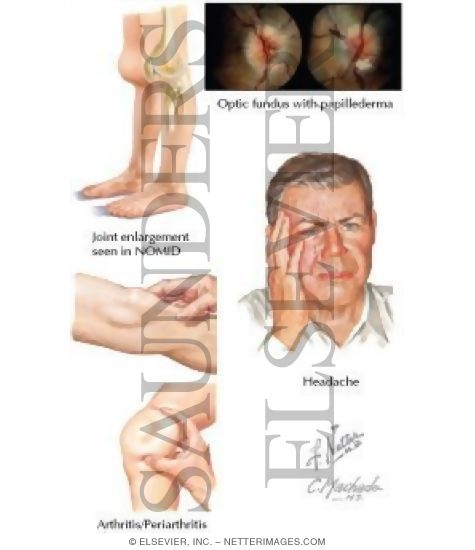 Watermarked preview of labeled image: Joint and Central Nervous System Findings In Autoinflammatory Syndromes