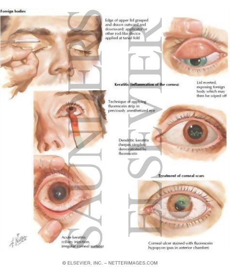 Watermarked preview of labeled image: Diagnostic Approach to Ocular Diseases