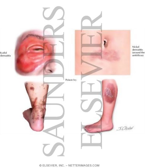 Watermarked preview of labeled image: Allergic Contact Dermatitis