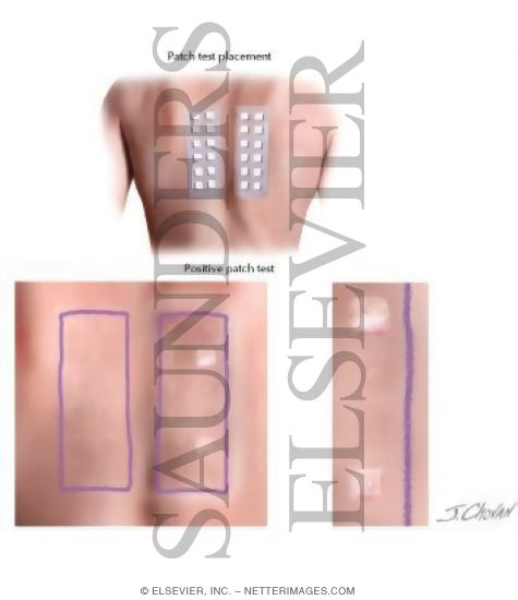 Watermarked preview of labeled image: Patch Test for Allertic Contact Dermatitis