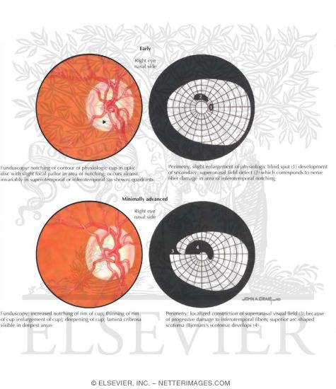 Watermarked preview of labeled image: Optic Disc and Visual Field Changes In Glaucoma