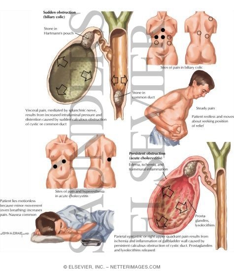 Mechanisms of Biliary Pain