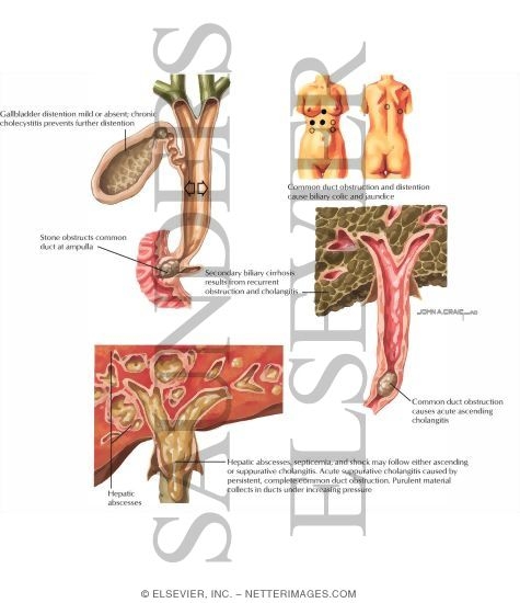 Watermarked preview of labeled image: Calculous Obstruction of Common Duct (Choledocholithiasis)