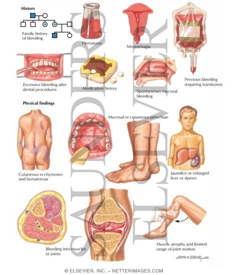 Watermarked preview of labeled image: Clinical Presentation of Patients With Bleeding Disorders