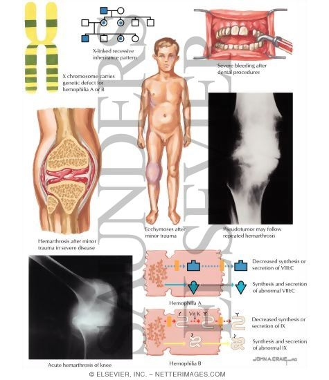 Watermarked preview of labeled image: Hemophilia A and B