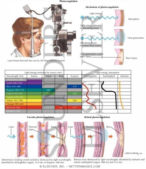 Watermarked preview of labeled image: Photocoagulation