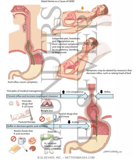 Symptoms and Medical Management of Sliding Esophageal Hiatus Hernia