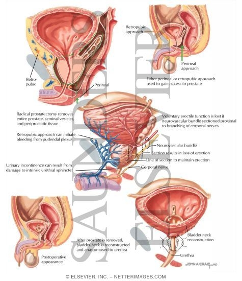 Watermarked preview of labeled image: Radical Prostatectomy