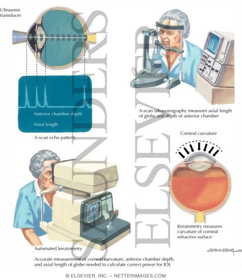 Watermarked preview of labeled image: Intraocular Lens (IOL) Studies