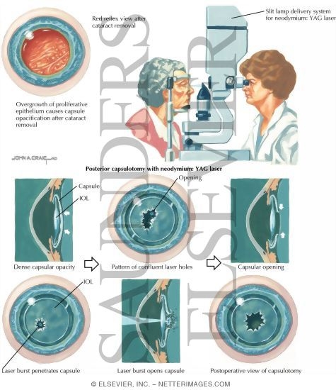 Posterior Capsule Opacification In Examination for Cataracts