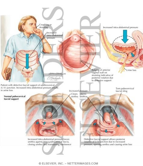 Urinary Incontinence: Bypass, Overflow, Stress, and Urge