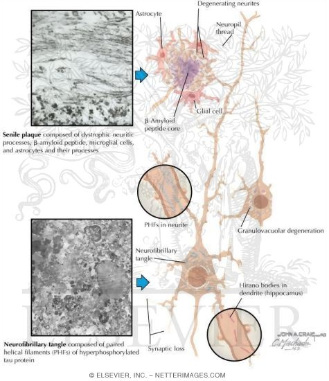 Watermarked preview of labeled image: Microscopic Pathology In Alzheimer's Disease