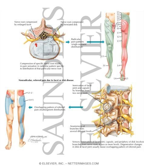 Watermarked preview of labeled image: Pain Patterns in Lumbar Disease