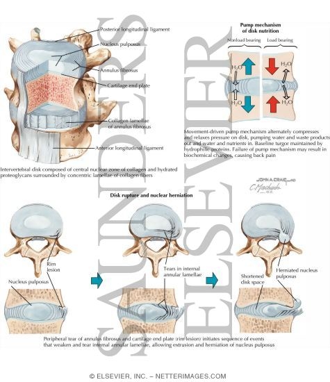 Watermarked preview of labeled image: Intervertebral Disc