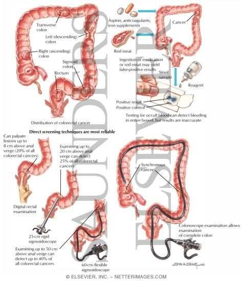 Watermarked preview of labeled image: Colorectal Cancer: Screening Techniques