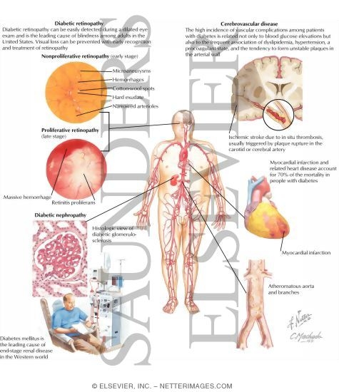 Watermarked preview of labeled image: Diabetes Mellitus and Its Complications: Micro and Macrovascular Complications