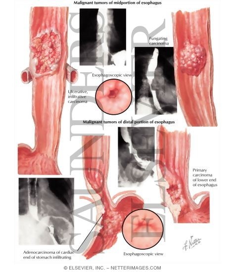 Malignant Tumors of Midportion and Distal Portion of Esophagus