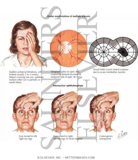 Watermarked preview of labeled image: Multiple Sclerosis: Ocular Manifestations of Multiple Sclerosis