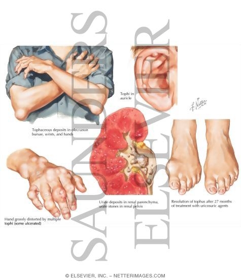 Tophaceous Gout
Gouty Arthritis