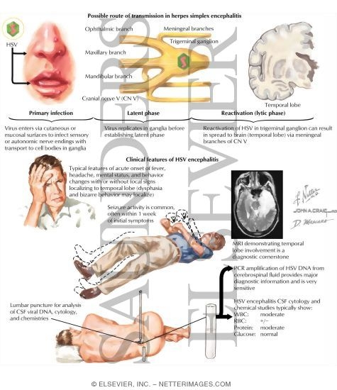 Herpes Encephalitis Herpes Encephalitis