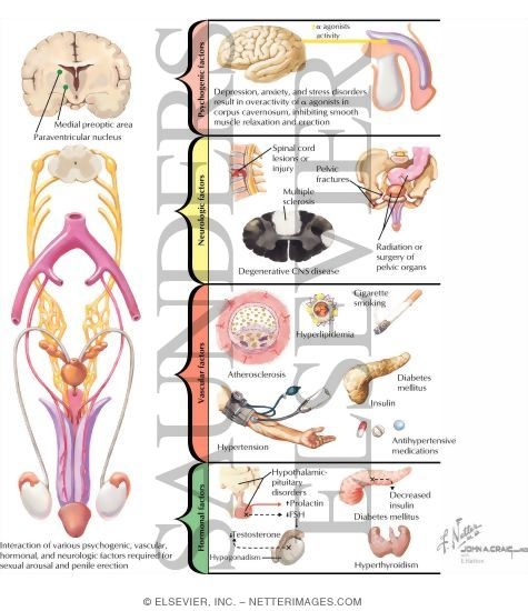 Watermarked preview of labeled image: Etiology and Pathogenesis of Erectile Dysfunction