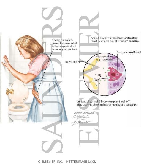 Watermarked preview of labeled image: Irritable Bowel Syndrome