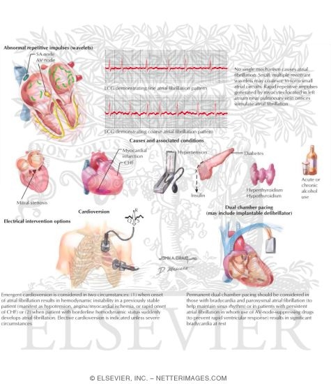 Watermarked preview of labeled image: Atrial Fibrillation