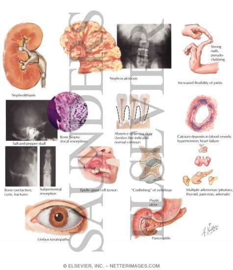 Watermarked preview of labeled image: Pathology and Clinical Manifestations of Hyperparathyroidism
