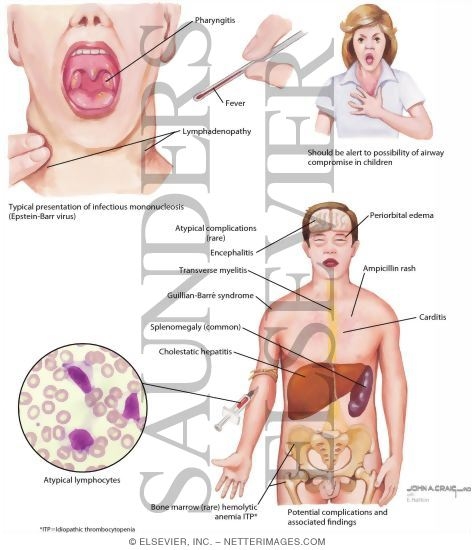 Infectious Mononucleosis