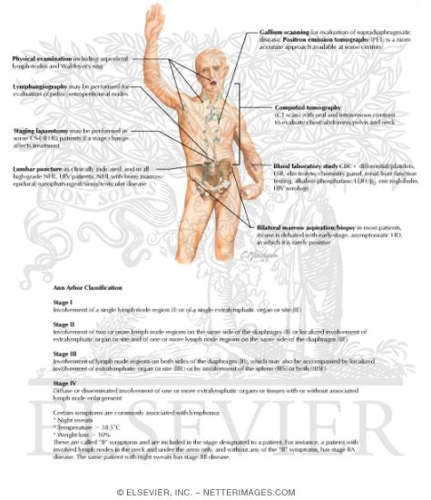Watermarked preview of labeled image: Malignant Lymphomas - Staging