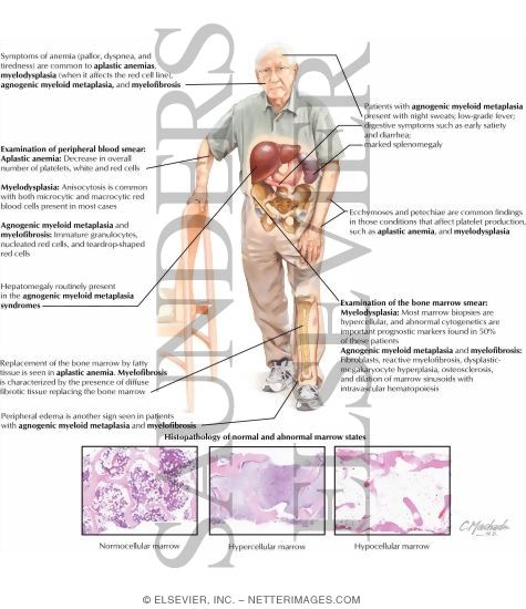 Watermarked preview of labeled image: Bone Marrow Failure